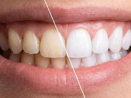 Close-up of woman’s smile before and after teeth whitening treatment