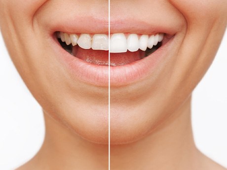 Smile that’s been halved to show before/after results of cosmetic services