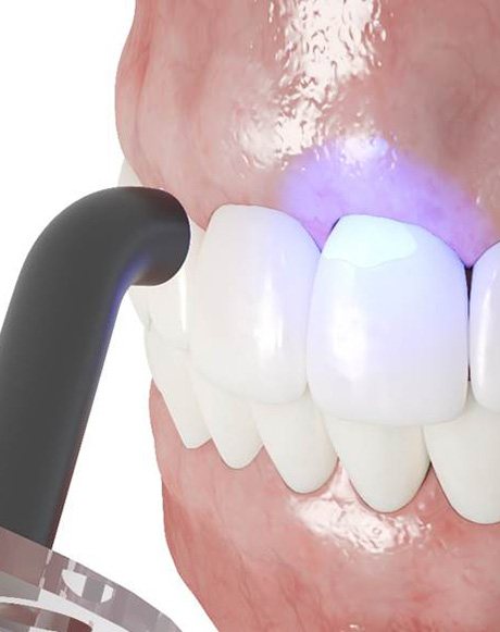A 3D illustration of the dental bonding process