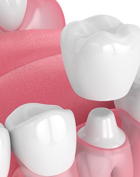 illustration of dental crown being fitted over tooth 