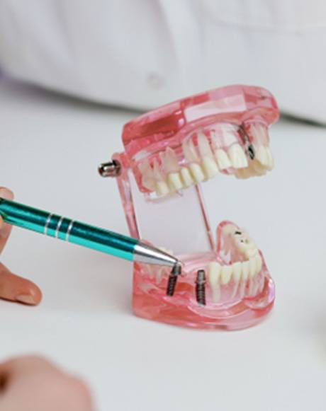 A dentist showing an implant bridge 