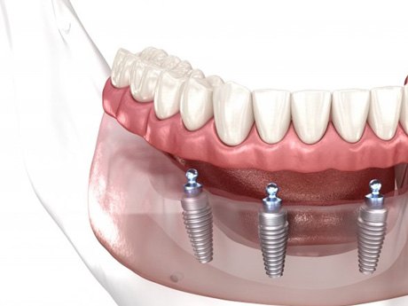 a 3 D illustration of All on 4 dentures