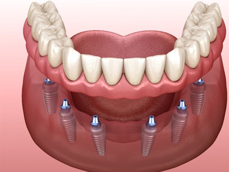 Implant dentures in Huntsville  
