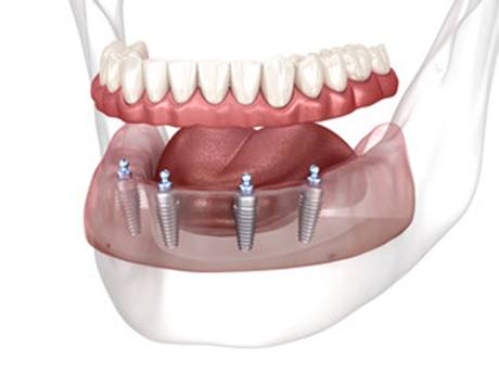 3-D diagram of some Implant dentures