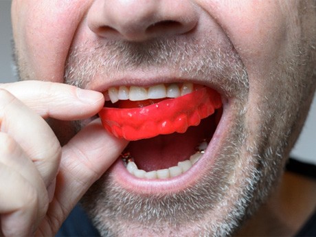 man putting mouthguard in to prevent dental emergencies in Huntsville
