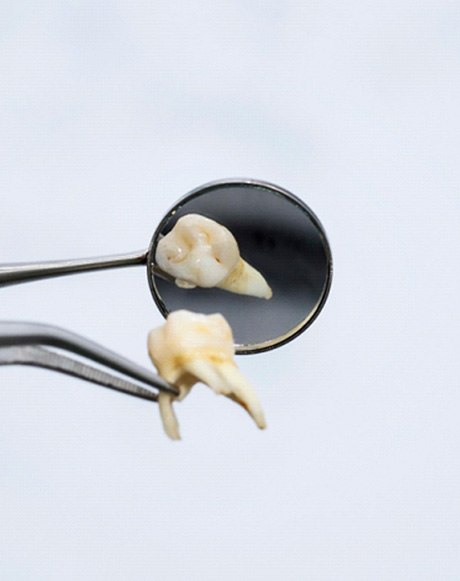 Close-up of forceps, dental mirror, and tooth after tooth extraction in Huntsville, OH