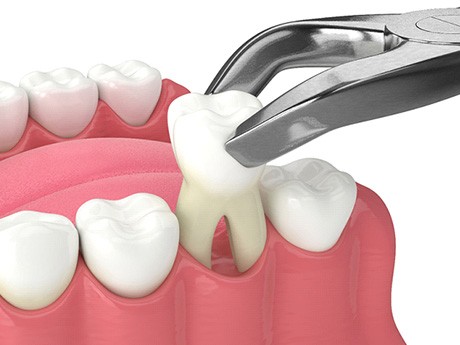 Illustration of a tooth extraction in Huntsville, OH