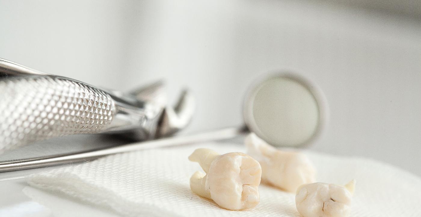 Close-up of multiple teeth after tooth extraction in Huntsville, OH