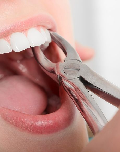 Close-up of a simple tooth extraction in Huntsville, OH