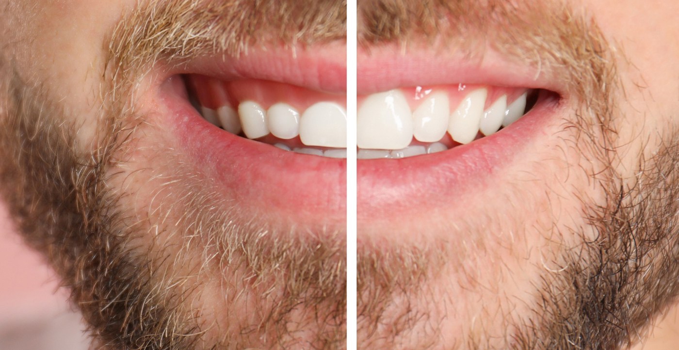 A man’s smile before and after gum recontouring