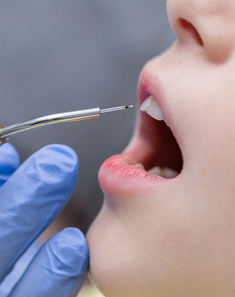 A gum recontouring procedure
