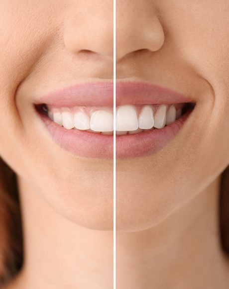 A woman before and after gum recontouring