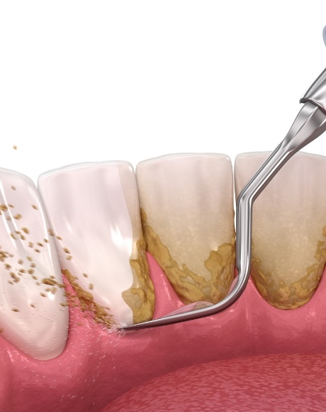 Animated smile during scaling and root planing treatment