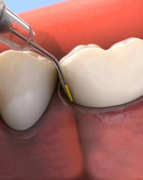 Animated smile during antibiotic therapy