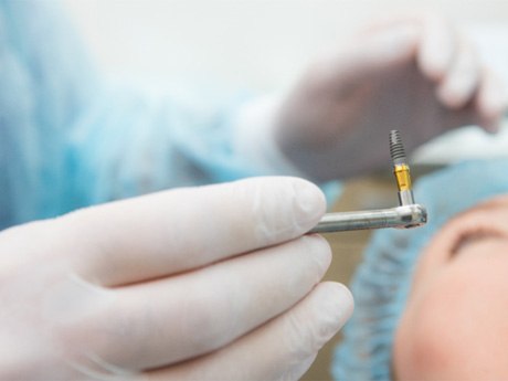 surgery for cost of dental implants in Huntsville
