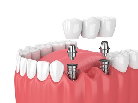 implant bridge illustration for cost of dental implants in Huntsville    