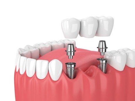 implant bridge illustration for cost of dental implants in Huntsville