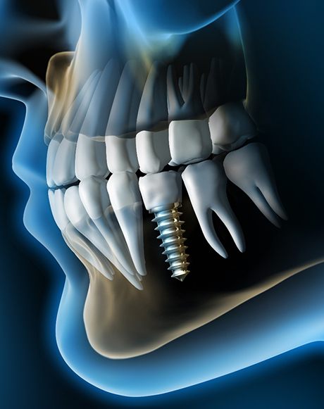 X ray of a person with a dental implant