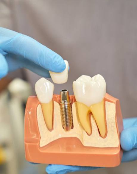 dentist putting a crown on a dental implant model