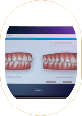 iTero showing smiles on screen