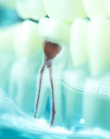 Model tooth demonstrating the results of root canal therapy