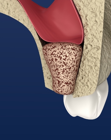 Animated smile after tooth extractions