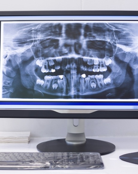 Digital dental x-rays on chairside computer screen