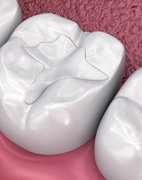 A 3D illustration of tooth-colored fillings