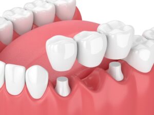 Animated model of dental bridge.
