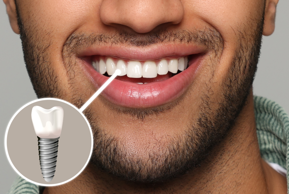 Close up of man's mouth w/dental implant